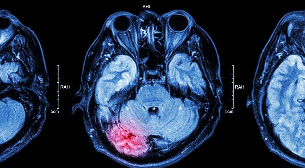 Traumatic Brain Injury