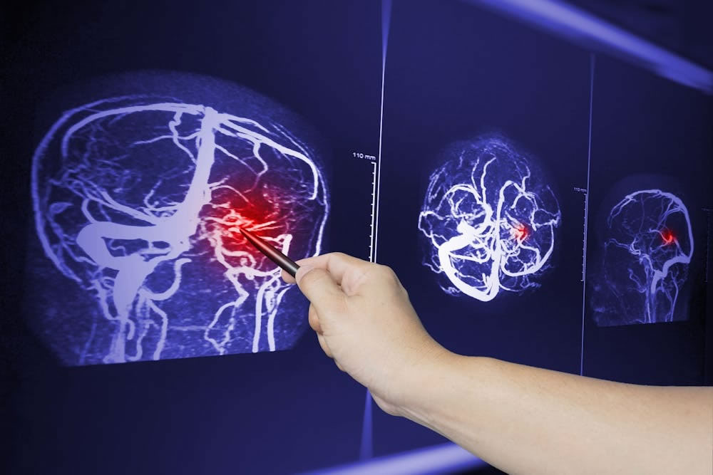 Serious Brain Injury from an Accident